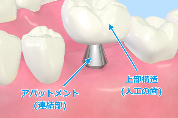 人工歯の作成・装着