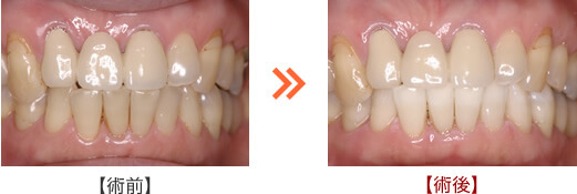 下の前歯をホワイトニングしました。