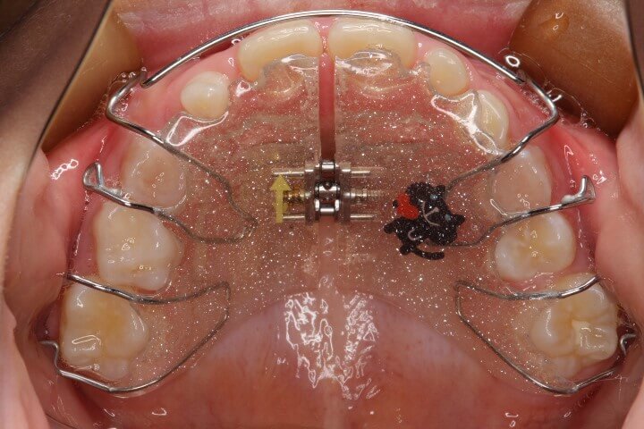 床矯正装置を使用した矯正例上あご