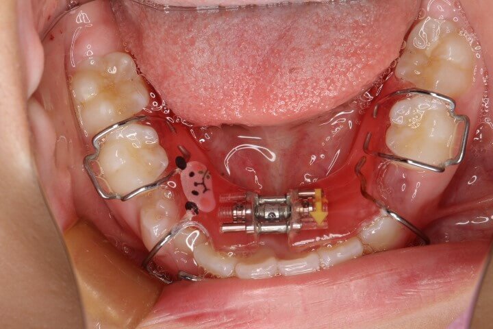 床矯正装置を使用した矯正例下あご