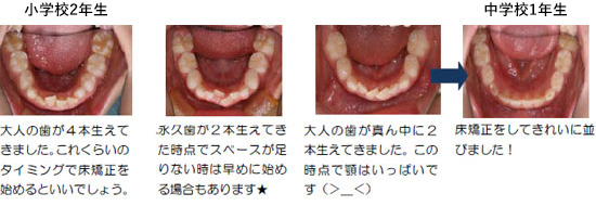 床矯正装置を使用した矯正例